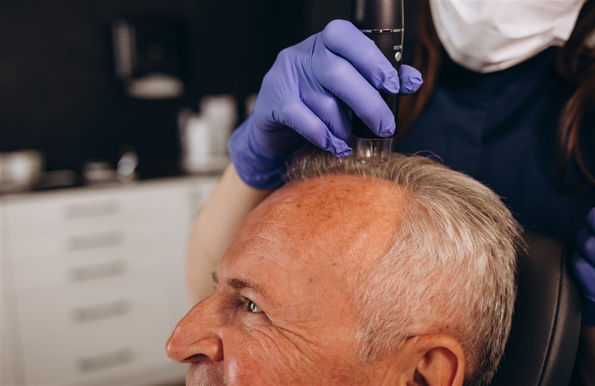 technique de pointe en greffe de cheveux